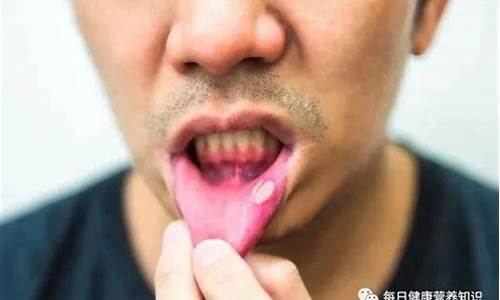 电子烟舌头溃疡了(电子烟 嘴巴溃疡)