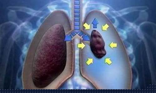 电子烟胸疼(抽烟电子烟胸口有点痛什么情况)